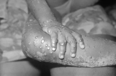 MonkeyPox: Rare Disease Hits Bayelsa, 10 Quarantined