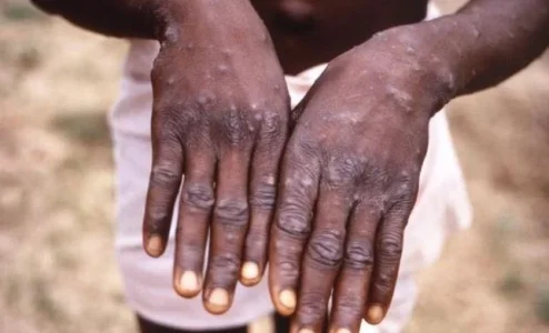 Anambra: Parents Rush To Withdraw Children From School Over Monkeypox Injections
