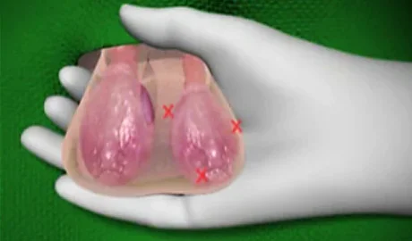 scrotum transplant - us metro news.jpg scrotum transplant - us metro news.jpg