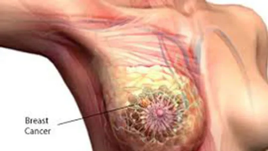 Breast-Cancer-17-09-17-1062x598.jpg Breast-Cancer-17-09-17-1062x598.jpg