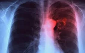 tuberculosis.jpg tuberculosis.jpg