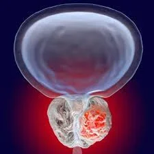 prostate.jpg