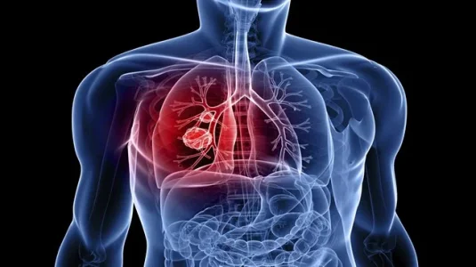 lung cancer.jpg lung cancer.jpg