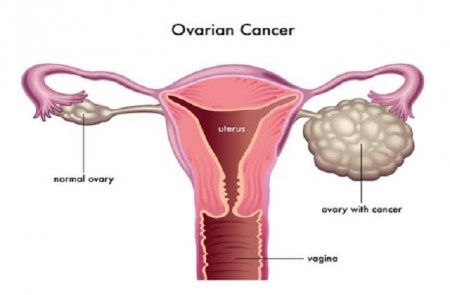 ovarian cancer.jpg
