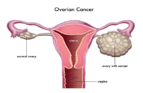 Ovarian cancer signs and symptoms