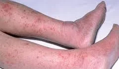 MENINGITIS.jpg MENINGITIS.jpg