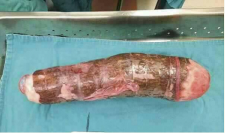 Woman With The Biggest Thing In Her Vigina | world lady hospitalised after cassava got stuck in her Woman With The Biggest Thing In Her Vigina | world lady hospitalised after cassava got stuck in her